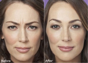 botox før og efter